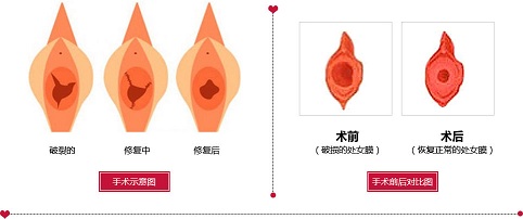 杭州做处女膜修复多少钱？